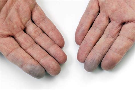 white feet|Raynaud’s Phenomenon: Causes, Signs, and。